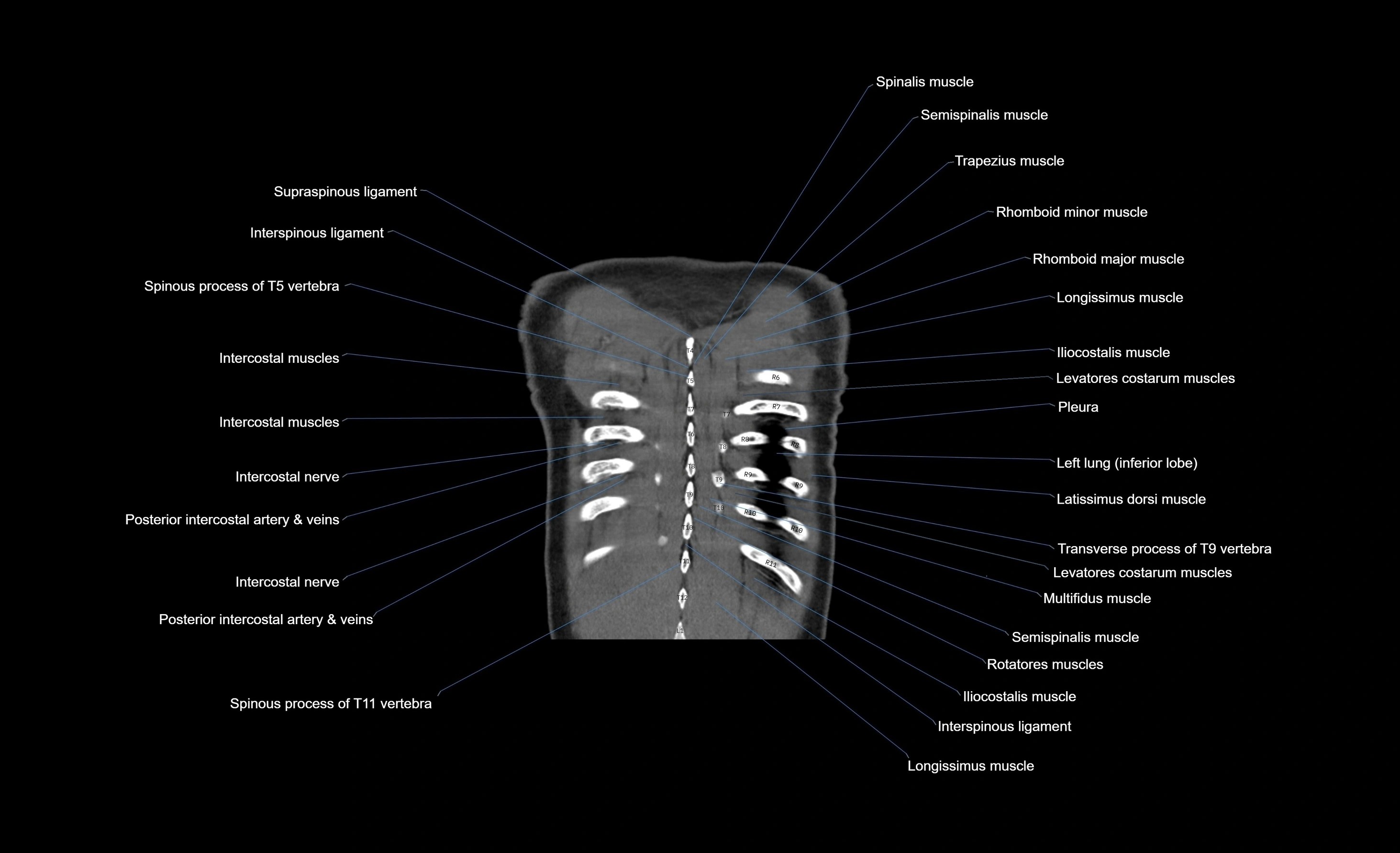 CT chest (thorax) soft tissue window labelled coronal cross sectional anatomy radiology image-00013.webp